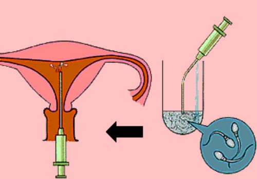 导致女性患有子宫腺肌症的原因你知道吗？